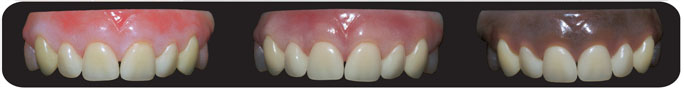 Cosmetic dentures